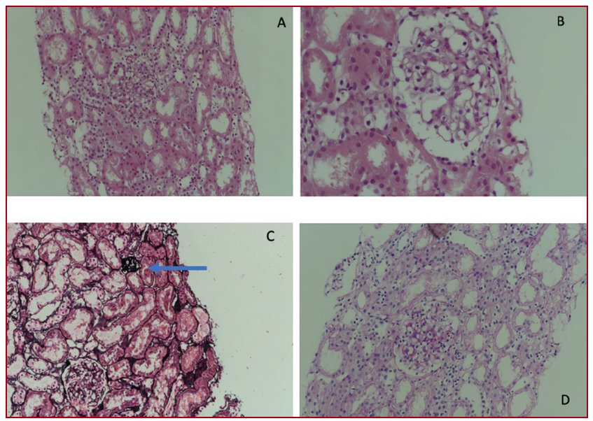Figure 1: A, B. In light microscopic examination, the glomerulus is closely related to Bowman’s capsule and distance narrowed. C, Global sclerotic glomeruli in Jones methenamine silver stain. D, Closely related appearance of tuft and capsule in PAS stain