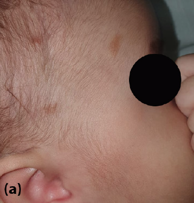 (a) Brown macules and papules located on the head, (b) Erythematous brown macules located on the back, (c) Darier's sign positive lesion on the back